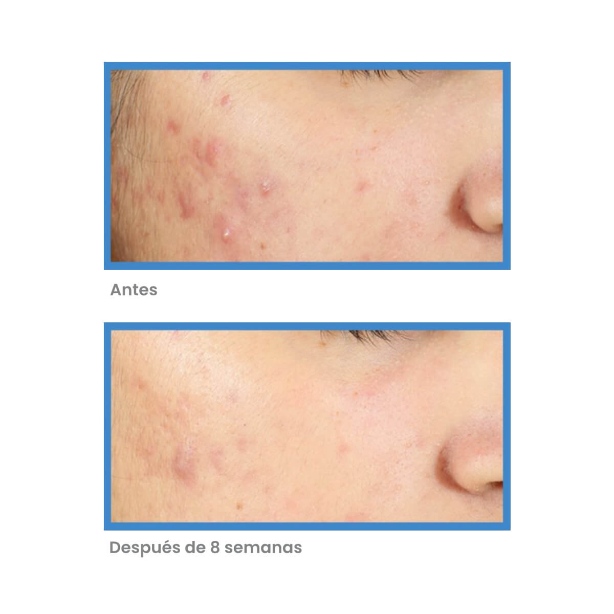 DEEP RELIEF BLEMISH TREATMENT (TRATAMIENTO PARA ACNÉ SEVERO)